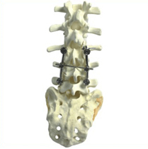 Spine Implants, Spinal System India